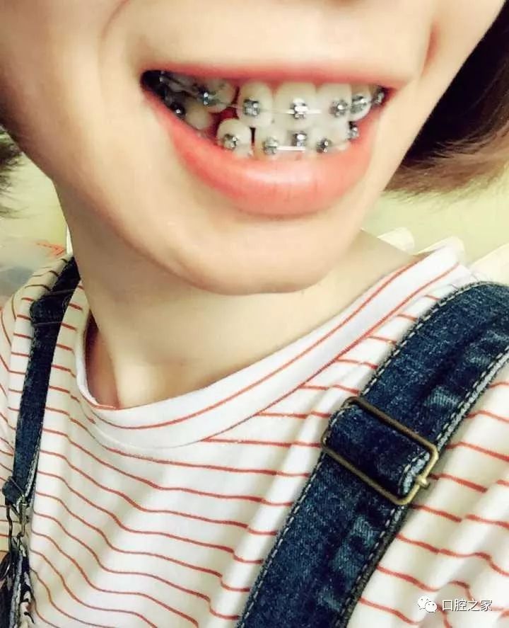虎牙妹的牙齿矫正变身记:有什么比自己一点点