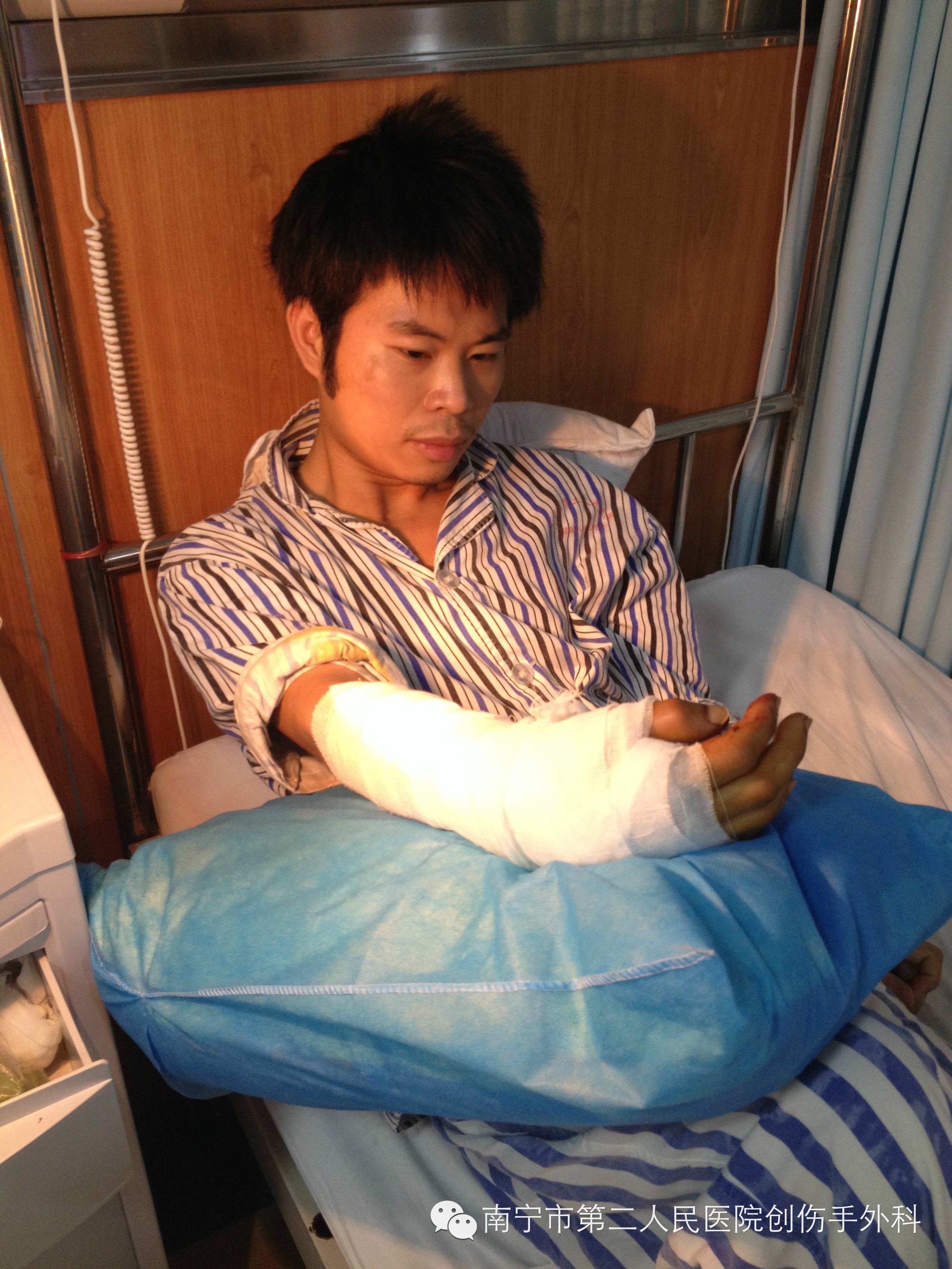 南宁市第二人民医院创伤手外科再次为患者行断