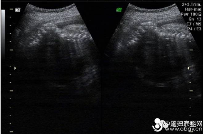 【超声笔记】NO.04 常见胎儿畸形的超声诊断