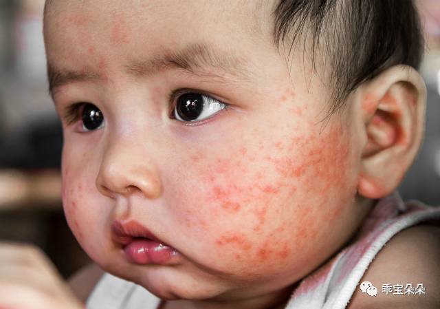 宝宝皮肤发红、脱皮、瘙痒可能是湿疹在搞鬼,