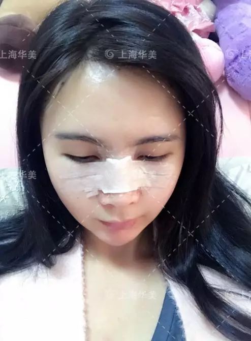 痘印 杭州和上海整形医院哪家好 0元鼻部案例