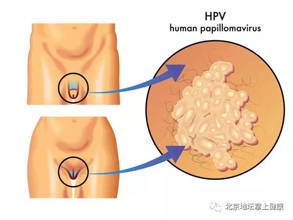 外阴长了小疙瘩,到底是不是尖锐湿疣?