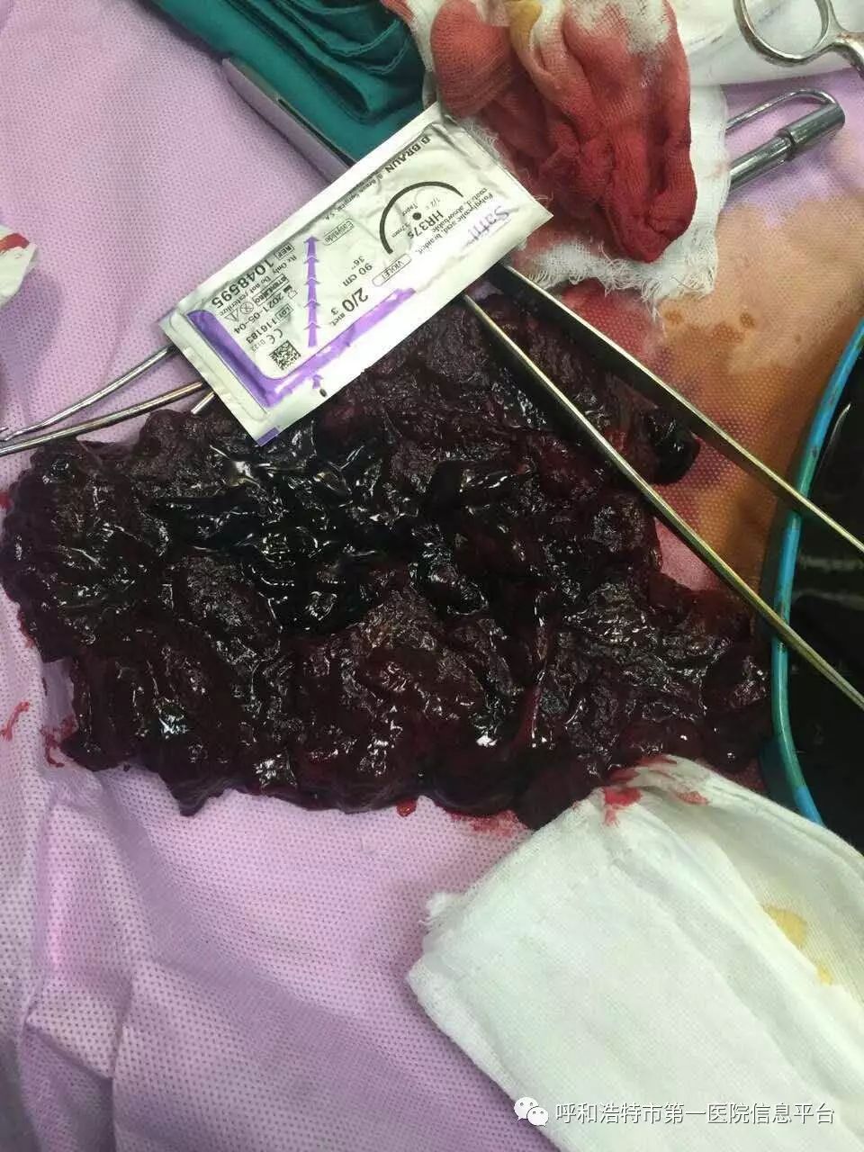 呼和浩特市第一医院产科病例分享--胎盘植入患