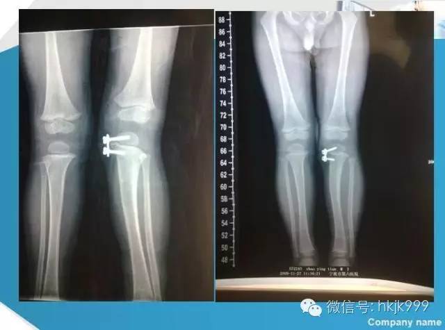 矫正小孩腿弯曲,听中国著名儿童骨科专家纠正