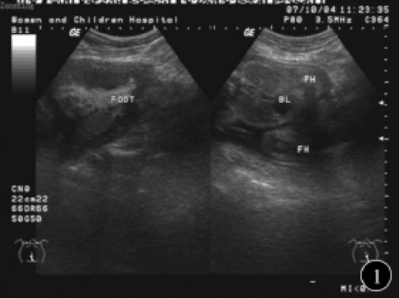 超声对胎儿肢体畸形的诊断体会