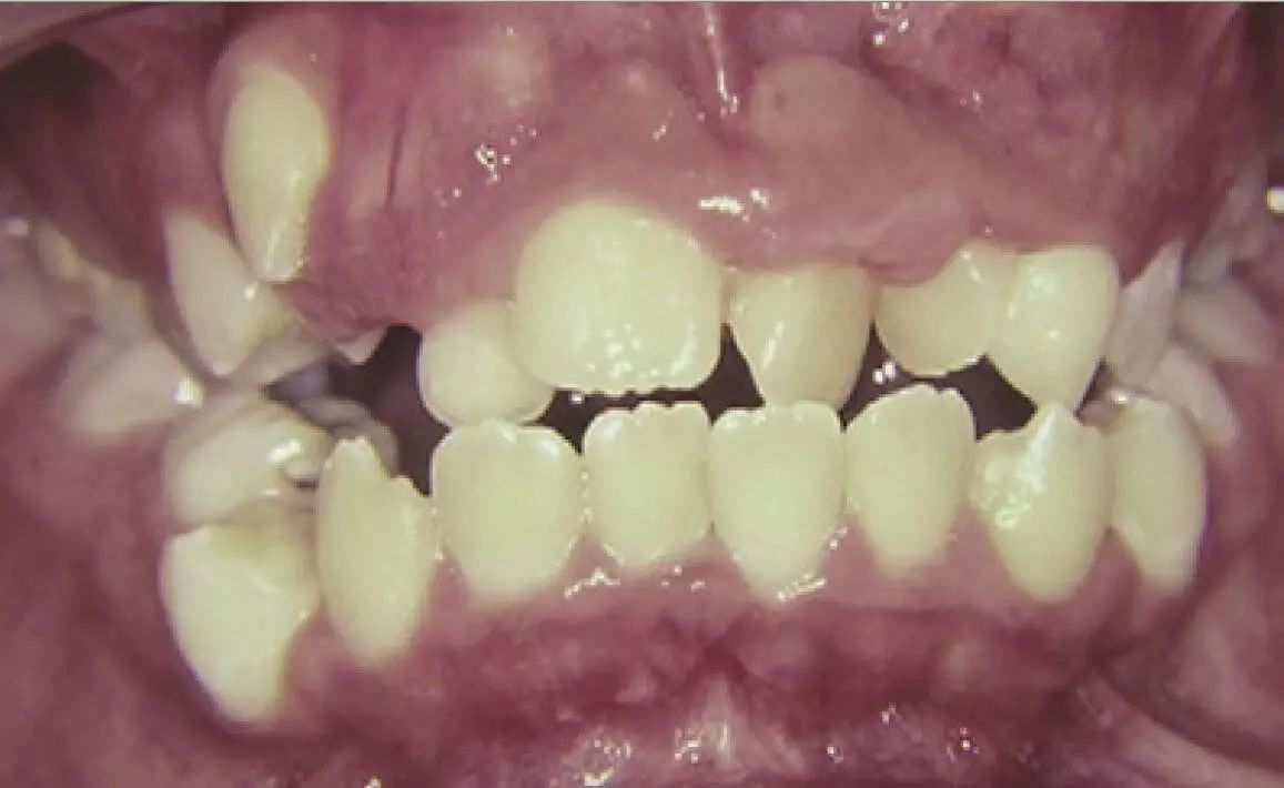 【非龋性牙体硬组织疾病】牙体发育异常临床诊
