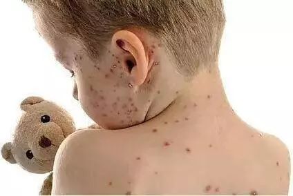 注意!西安多地区爆发水痘!最全水痘疫苗免疫接
