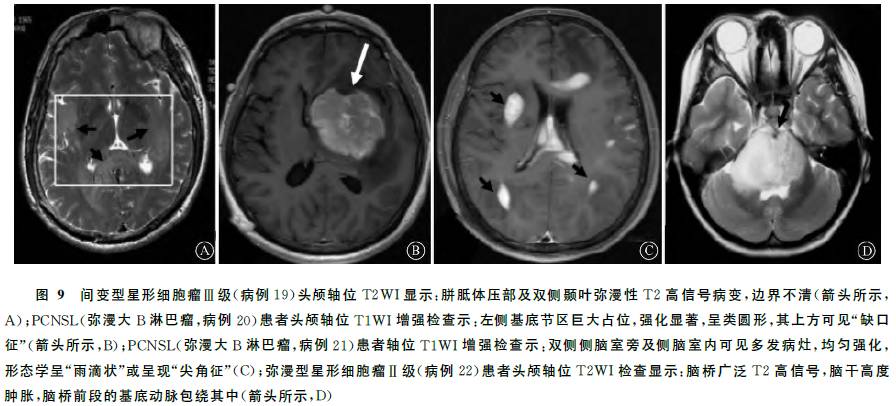 最新中枢神经系统瘤样脱髓鞘病变诊疗指南发布