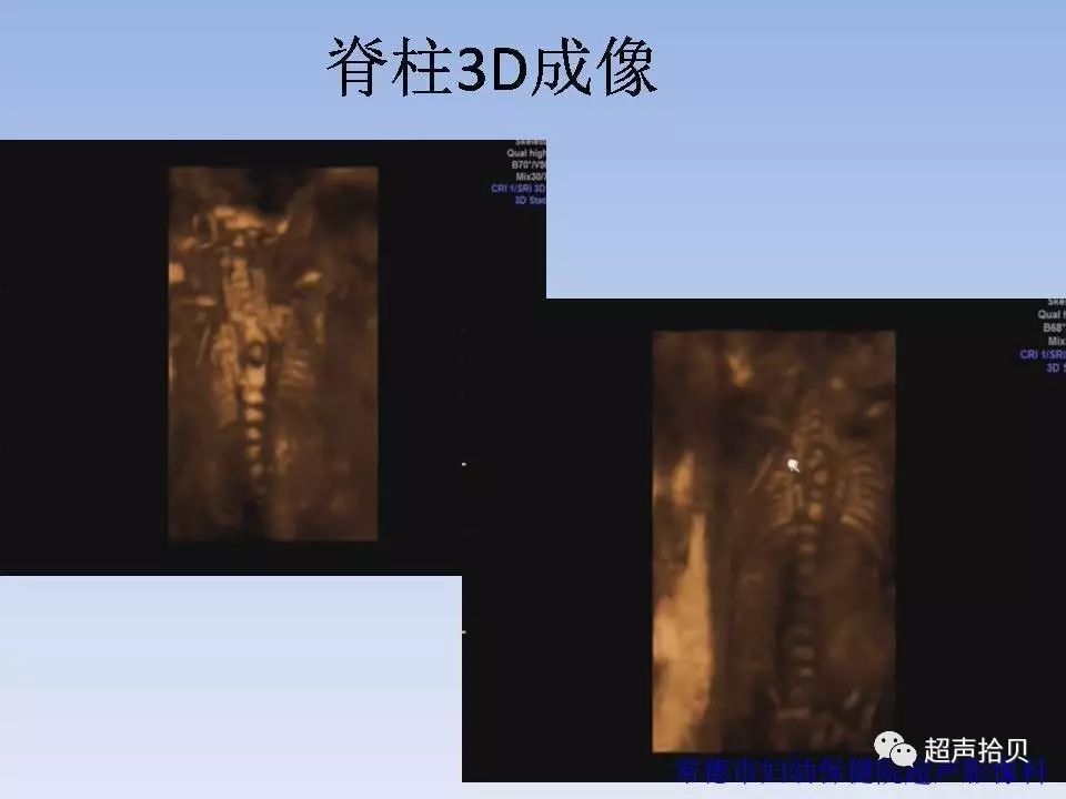 胎儿脊柱异常的超声检查系列(4)脊髓纵裂(上篇