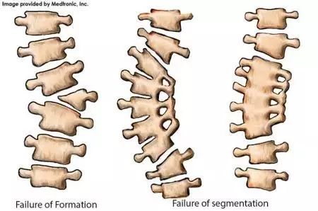 期半椎体切除+前柱钛笼重建治疗先天性脊柱侧