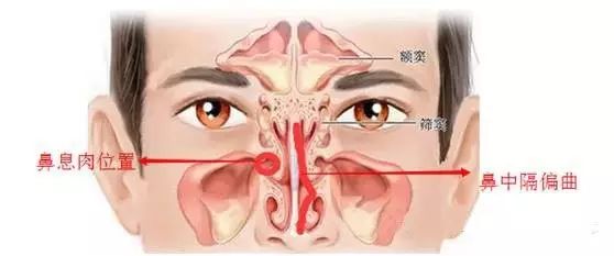 鼻塞、流鼻涕不容忽视 小毛病可能引发大疾病