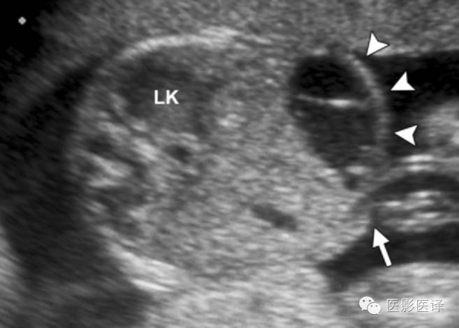 胎儿卵巢囊肿的影像学诊断与鉴别诊断