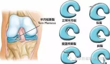 半月板损伤需要进行膝关节镜手术(微创技术)治