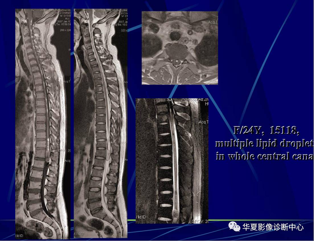 脊柱知识 | 椎管内皮样囊肿和表皮样囊肿及破裂