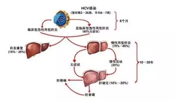 V阳性,就是丙肝吗?为什么还要检测HCV-RNA呢