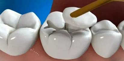牙医患者必看|补牙全过程(内含3D视频)