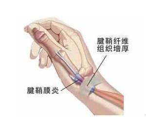 【征文大赛】拇指腱鞘炎的研究进展
