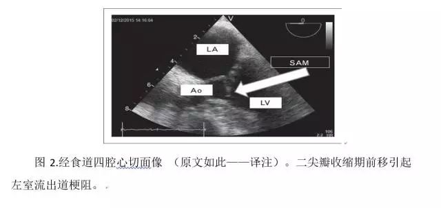 ICU患者中的左室流出道梗阻(1)