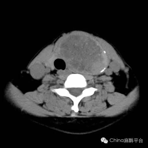 【病例讨论】巨大甲状腺肿瘤人工气道建立一例