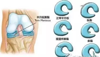 膝关节常见的运动损伤,膝盖要注意保养!
