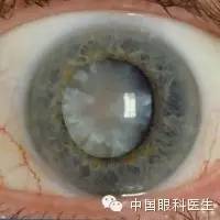 【病例】双眼视力逐渐下降3年,晶状体皮质混浊