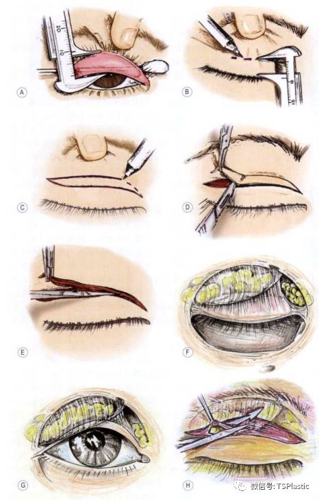 【长文科普】 现今所有十几种双眼皮手术方法