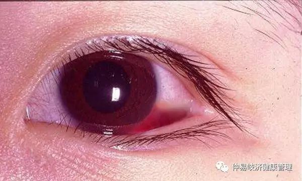 中医中药治疗白睛溢血、眼球结膜下出血