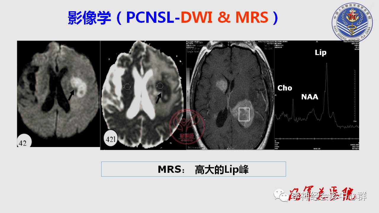 指南解读 完整版 | CNS瘤样炎性脱髓鞘病变TD