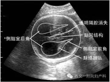 产科超声学习系列四 胎儿胼胝体发育不良