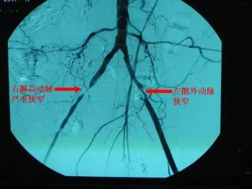 燕达医院介入治疗科:下肢动脉硬化闭塞症的微