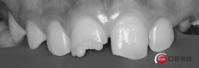 前牙复合树脂修复比色:从观察到模拟