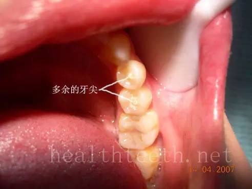 口腔常见疾病图片展(建议收藏)_水滴健康_水滴