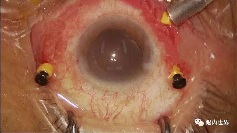松桃县人民医院眼科---微创玻璃体视网膜手术开