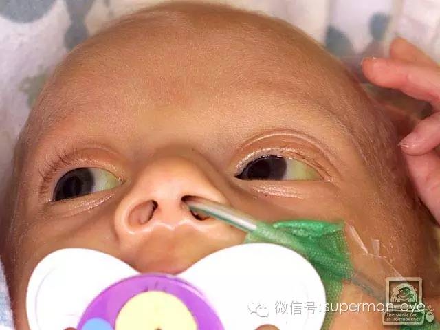 早产婴儿的眼睛健康需要注意哪些?