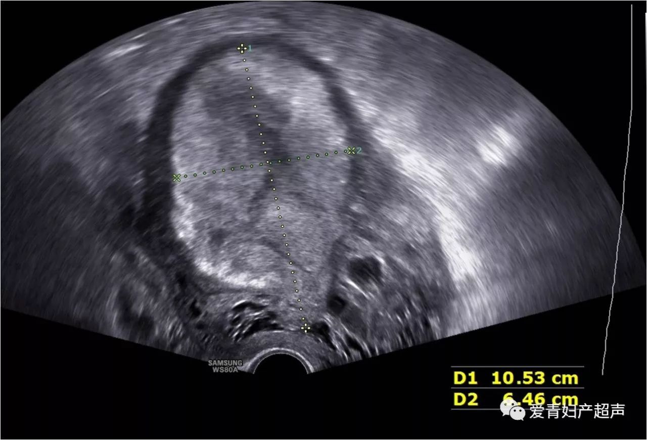 不离不弃的子宫与胎盘--产后胎盘植入超声诊断