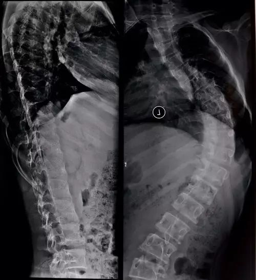 宜昌市中心医院脊柱外科--脊柱矫形篇