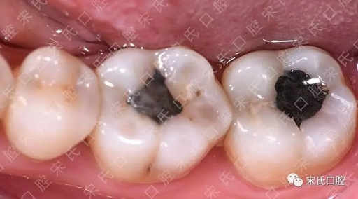 多年前用银汞补牙,现在要不要将银汞取出?