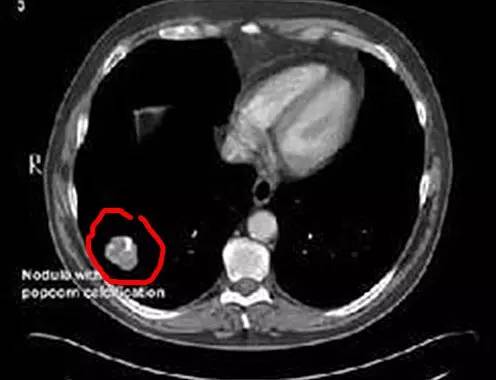 一次肺部CT吃多少放射线,筛查肺癌靠谱吗?