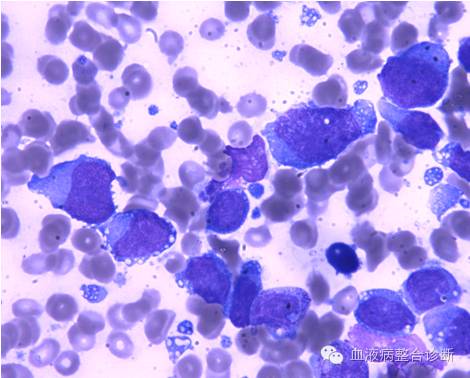 一例骨髓发现的大B淋巴瘤细胞白血病性骨髓侵