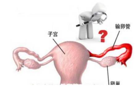 输卵管不孕,选择哪种检查方式比较好?丨合肥不