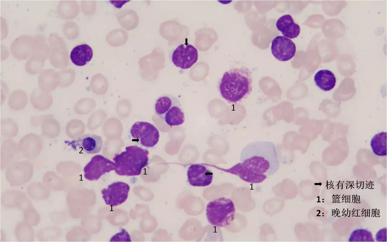 图110 空泡型异型淋巴细胞 (Ⅰ型)-血液学细胞学-医学