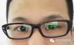 李绍伟眼科病例分析系列36-自幼角膜白斑