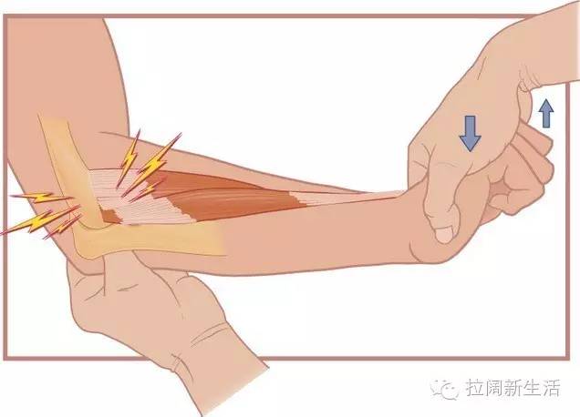 拉阔生活馆 | 网球肘鼠标手治愈指南