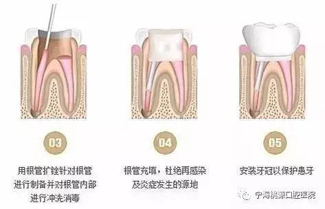 抽神经会伤牙?破解根管治疗的3大迷思~_水滴