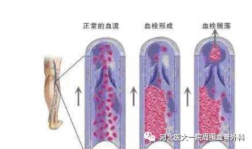 关心血管,让生命长流(静脉篇)_水滴健康_水滴筹