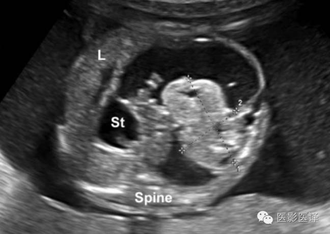 【图文详析】|| 胎儿卵巢囊肿的影像学诊断与鉴