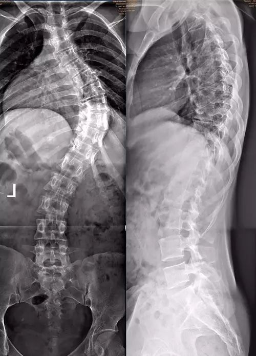 宜昌市中心医院脊柱外科--脊柱矫形篇