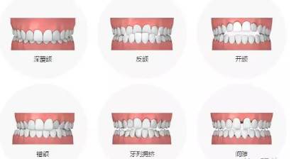 好想拥有一口整齐的牙齿,牙套怎么选、矫正大