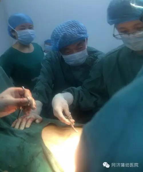 蒲纺医院成功开展首例巨大腹壁切口疝修补术
