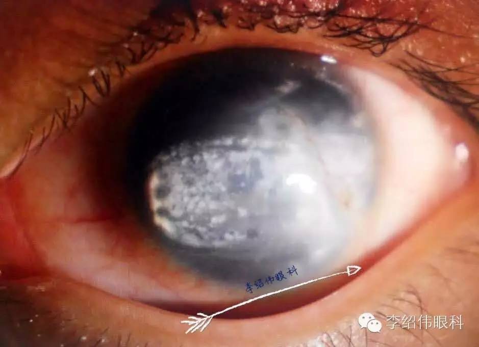 李绍伟眼科病例分析系列36-自幼角膜白斑